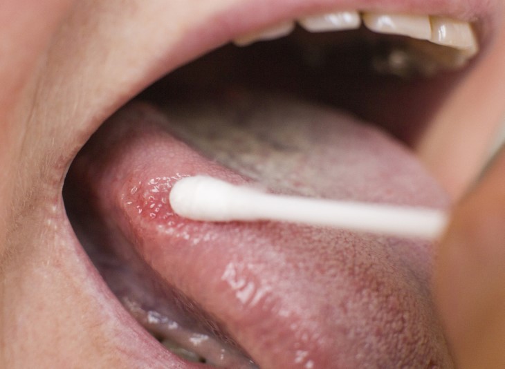 oral cancer