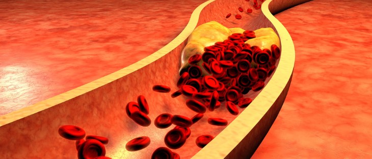 high cholesterol