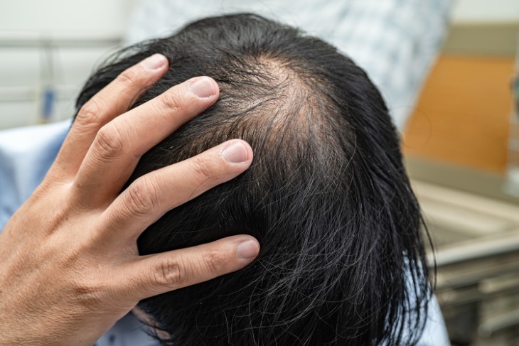 ozempic hair loss