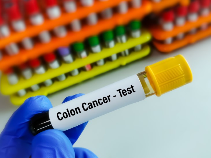 colon cancer and exercise