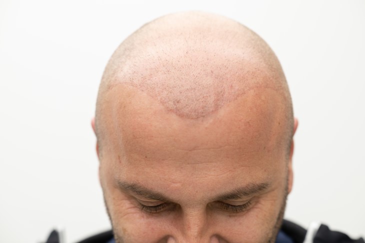 head bald skin treatment