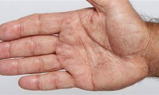 Rheumatoid Arthritis and Its Link to Lung Disease