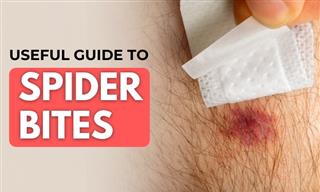 What Spider Bites Look Like and How to Treat Them At Home