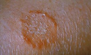 The Complete Guide to Ringworm