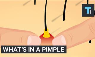 What's Really Inside a Pimple?