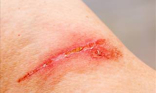 Great Home Remedies for Burns