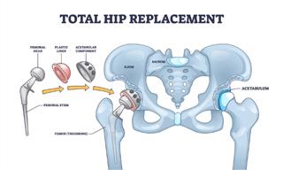 All About Hip Replacement Surgery