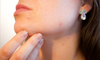 Why Pimples Develop On Particular Facial Areas