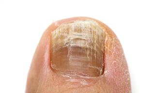 The Various Causes and Treatments of Yellow Toenails