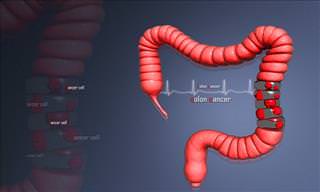 Who's Most At Risk of Colon Cancer? Find Out Here!