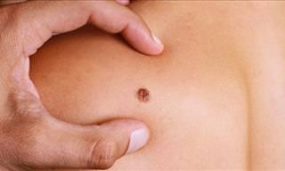 QUIZ: Is This Mole Cancerous, or Not?