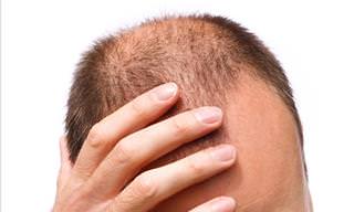 An Effective New Treatment for Balding