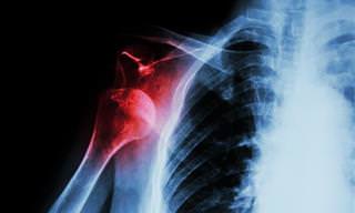 Medical Reasons for Shoulder Pain