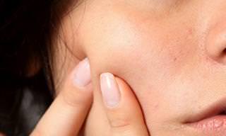 Leave These 7 Types of Bumps and Blemishes Alone