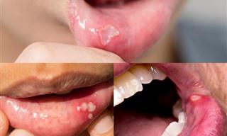 Causes, Symptoms and Remedies for Mouth and Tongue Ulcers