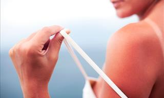 How to Recognize and Treat Sun Poisoning