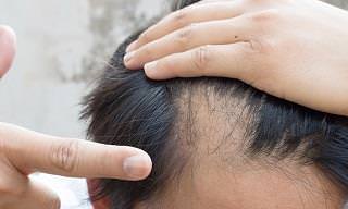 Learn All About Alopecia Areata