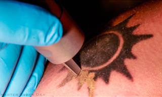 Science Lesson: How Does Laser Tattoo Removal Work?
