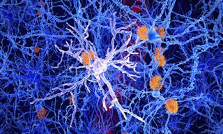 Brain Autopsies Find New Clue to Alzheimer's Disease