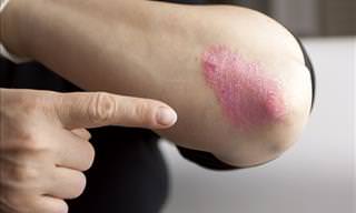 A Helpful Guide to Treat Psoriasis Naturally