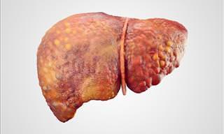 The Comprehensive Guide to Cirrhosis of the Liver