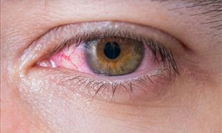 4 Simple Tips to Get Rid of Pink Eye at Home