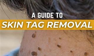 A Comprehensive Guide to Skin Tag Removal