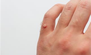 18 Effective and Natural Treatments for Removing Warts