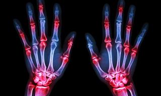 4 Stages and Progression of Rheumatoid Arthritis