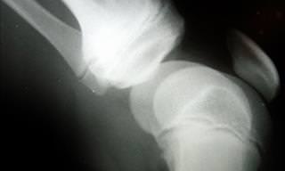 Bone Spurs: What They are and How to Treat Them