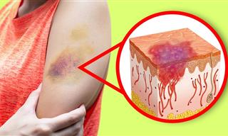 A Lack of Vitamin K Could be the Cause of Your Bruises