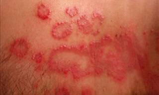 A Guide to Understanding Psoriasis