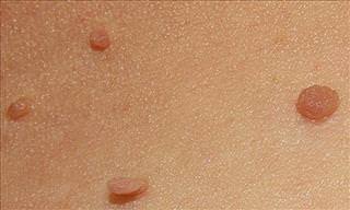 Apple Cider Vinegar Can Help You Lose Those Skin Tags