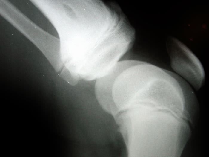 The Causes And Treatments Of Bone Spurs