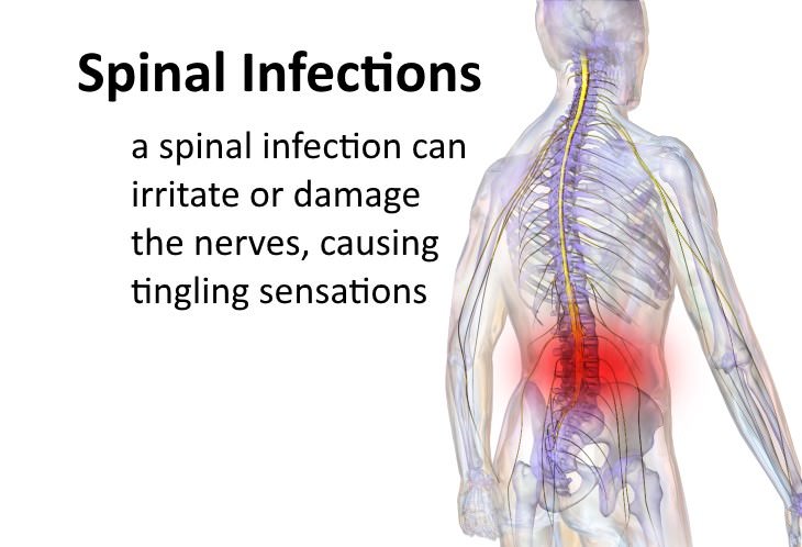 7 Serious Causes Of Tingling Sensations In The Back